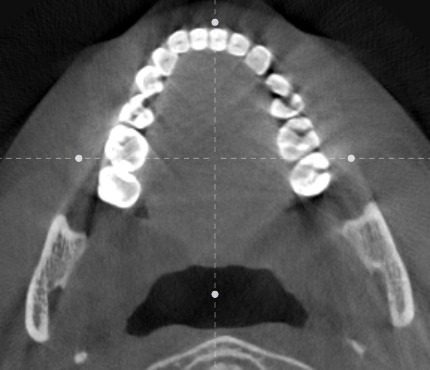 An axial CT slice through the upper jaw