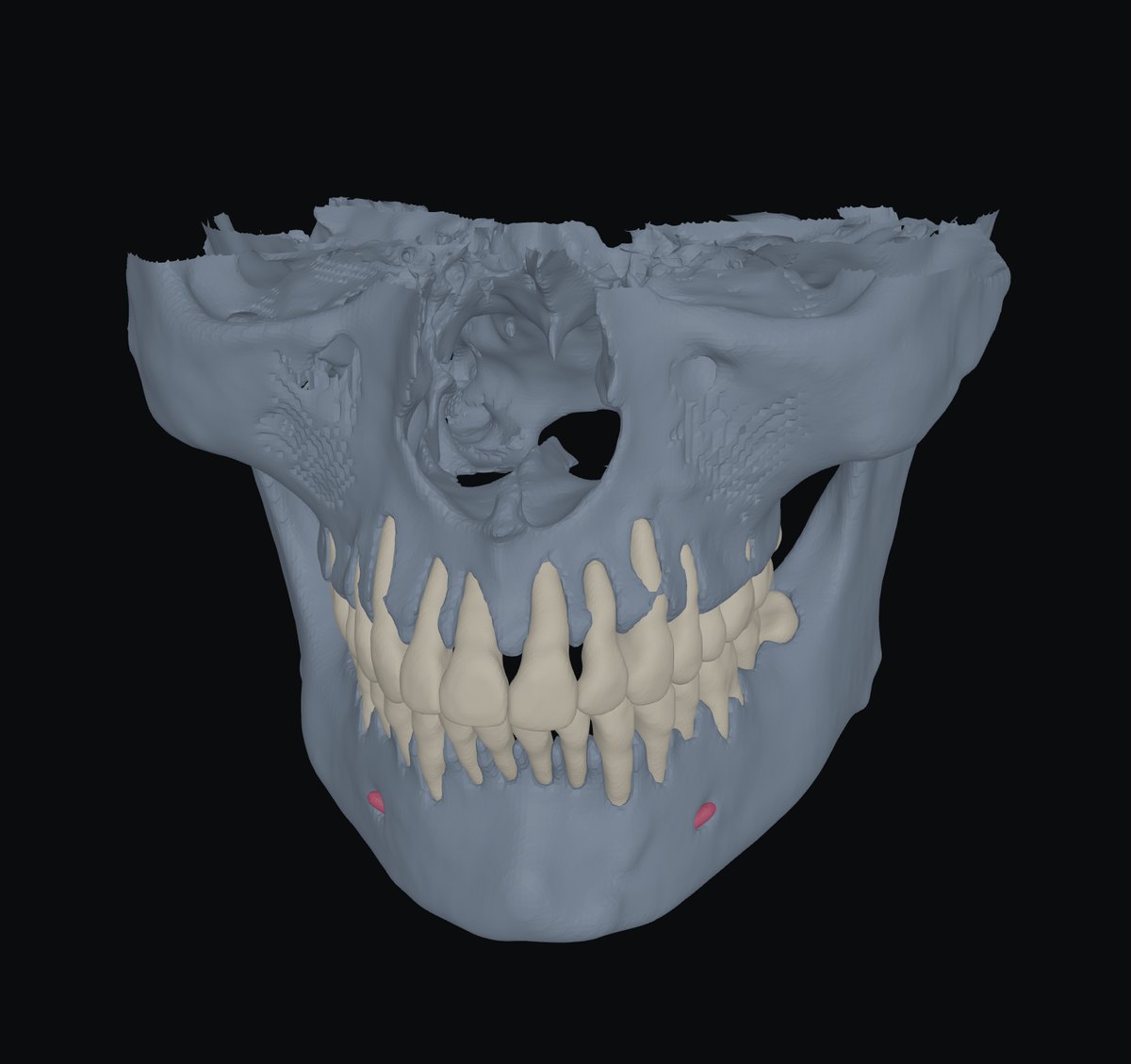 A segmented CT: teeth, both jaws and the nerve canal in 3D